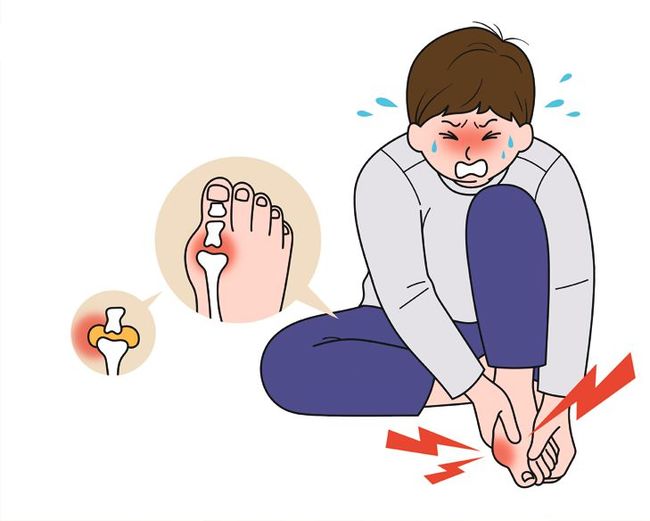통풍