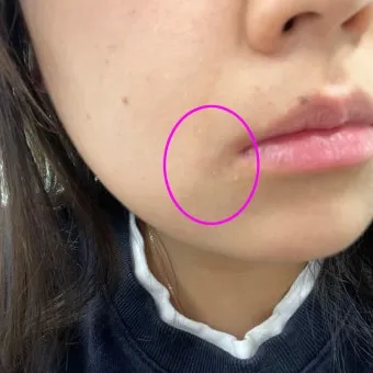 얼굴 버짐 증상 없애는 실전 방법 5가지 및 관리요령_16