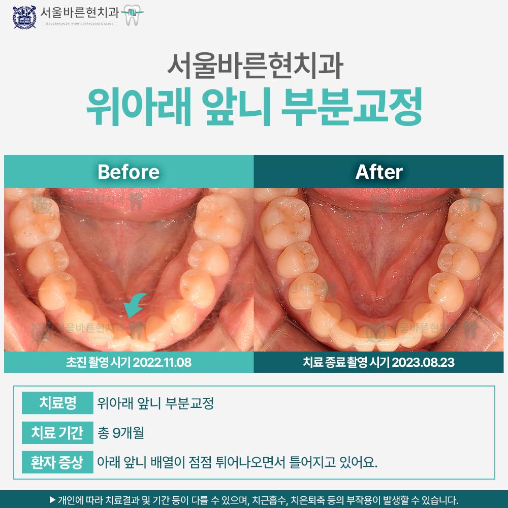 마린시티치아교정