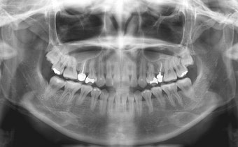 주기적인 치아 검진