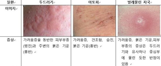 습진 가려움 집에서 응급 처치하는 방법