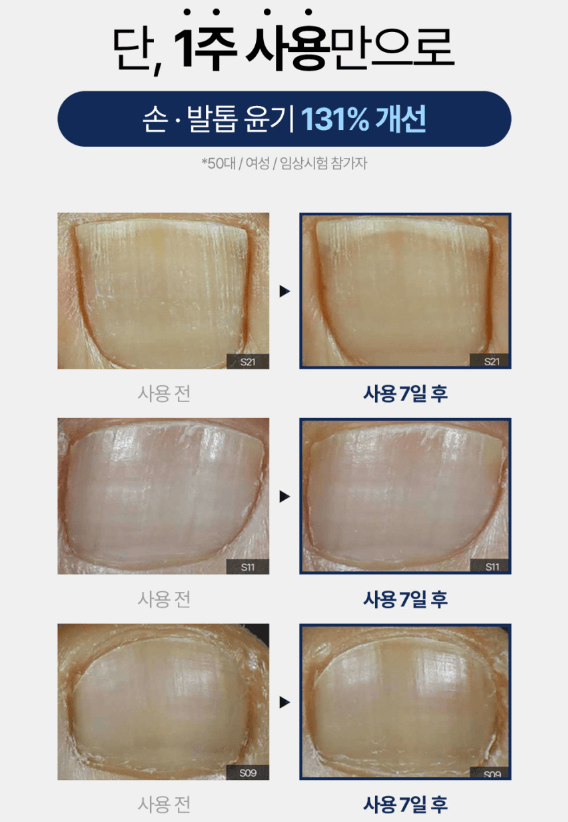 발톱 무좀 약 리얼큐어