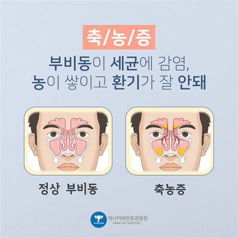 부비동염