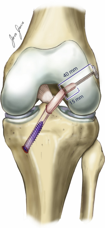전방십자인대 재건술