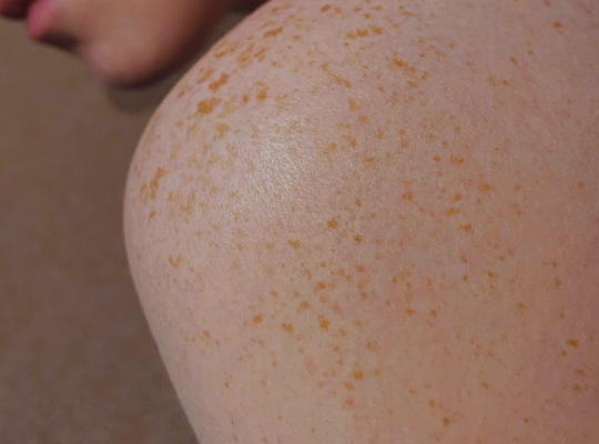 엉겅퀴 효능 : 피부