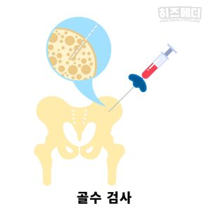 혈소판수치가 높으면