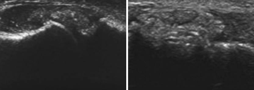 요산이 조직에 축적된 모습