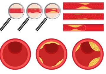 폴리코사놀 효능&amp;#44; 사탕수수가 중요한 이유&amp;#44; 나이가 들어 감에 따라 각종 질병에 노출되어 고혈압&amp;#44; 당뇨 등의 대사증후군을 일으키고 뇌심혈관질환으로 이어지게 됩니다.