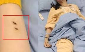 독사 물림&amp;#44; 이렇게 생깁니다-물린자국