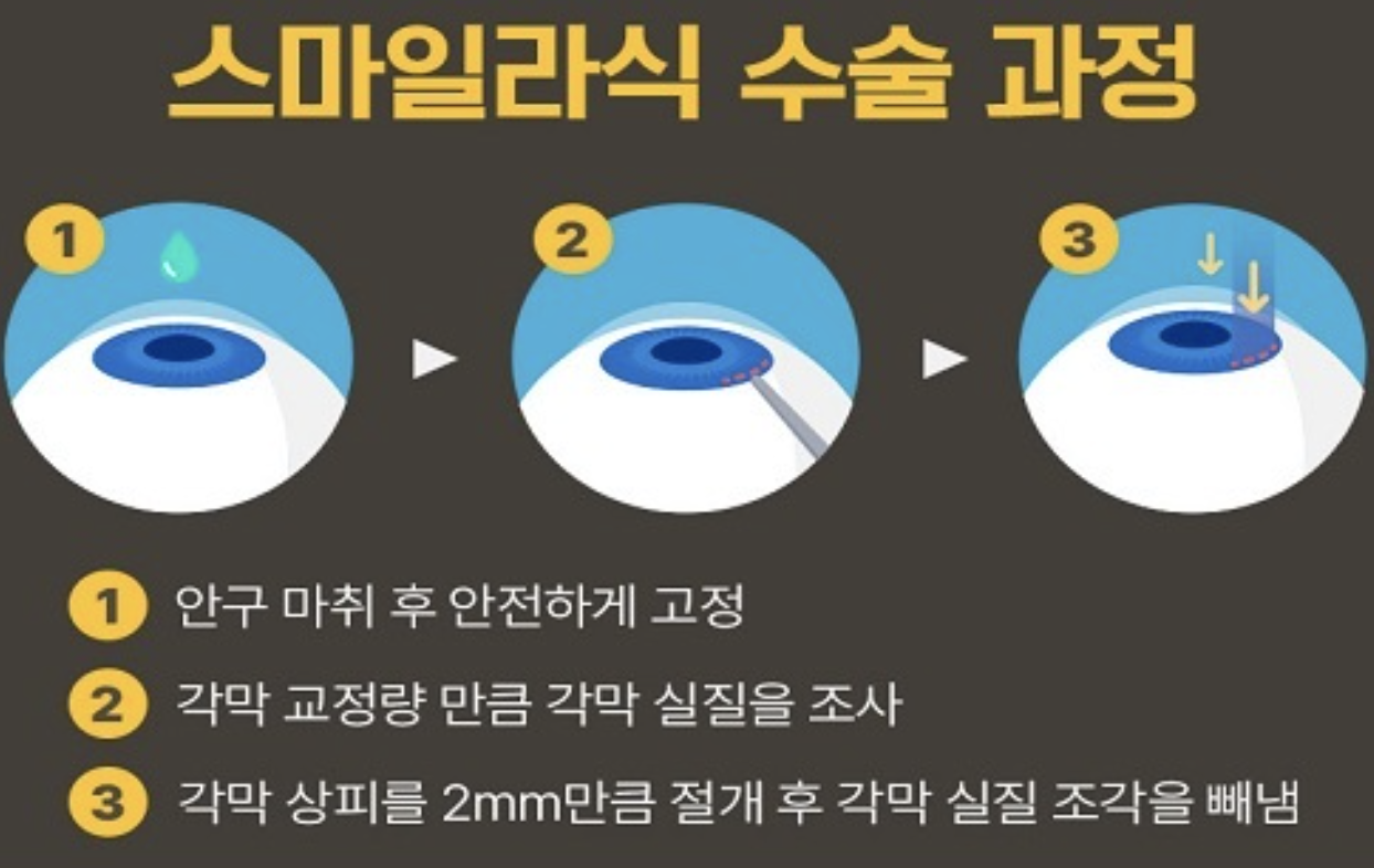 스마일-라식-수술