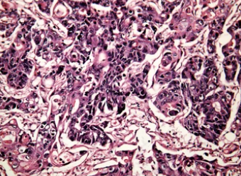 간암 말기 증상