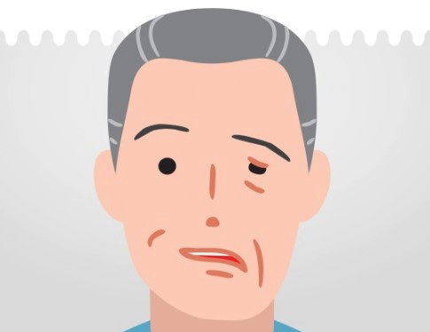 안면마비 고치는법