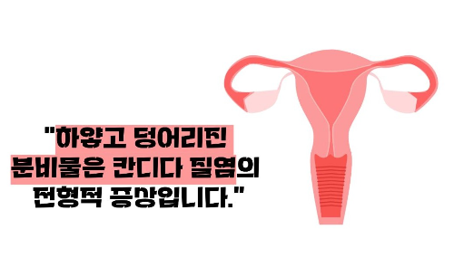 질염 증상 원인