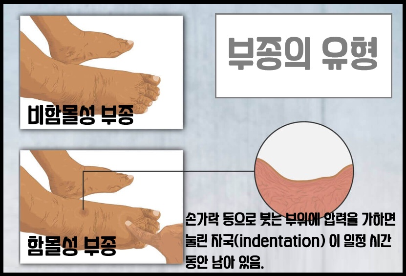 부종의 유형