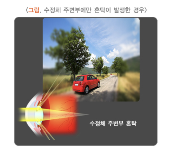 시력감퇴