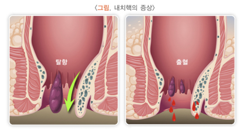 내치핵의 증상