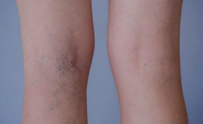 하지정맥류-수술비용