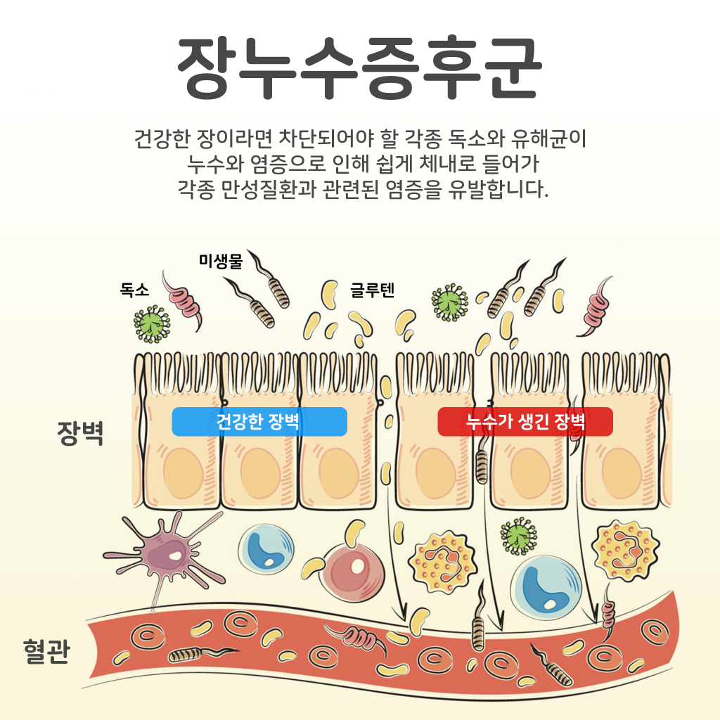 장누수증후군
