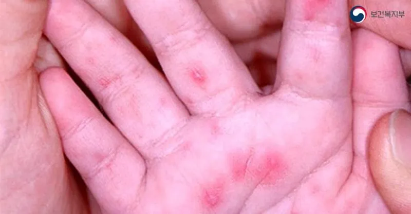 수족구병 증상과 예방 조치 방법 모음_5