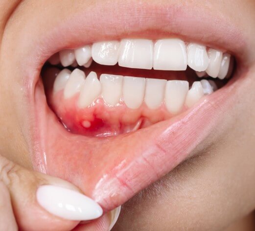 입안에 생긴 구내염