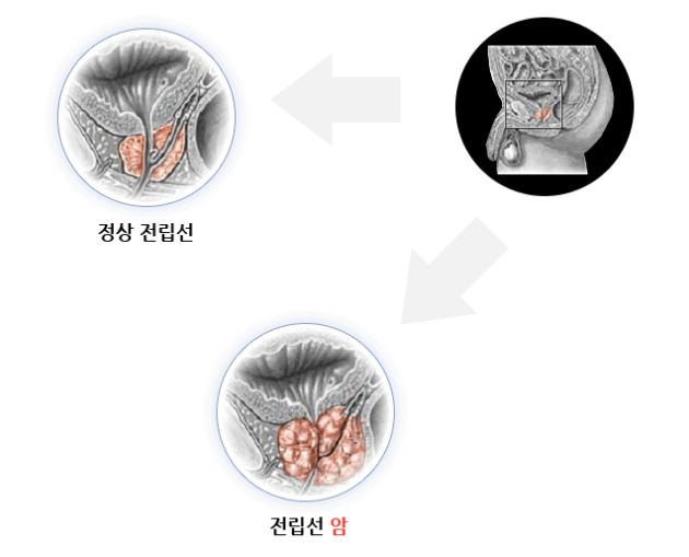 전립선암