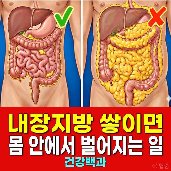 내장지방 질환