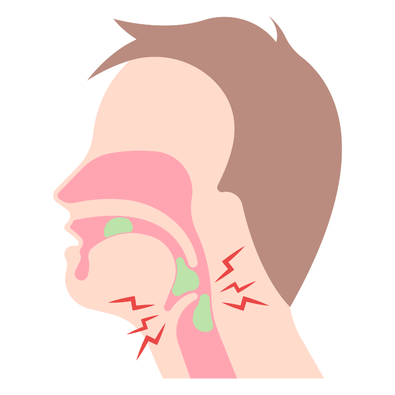 역류성 식도염 증상