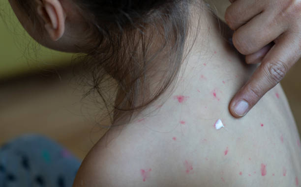 홍역 베트남홍역 홍역예방접종 등교가능여부 추가예방접종