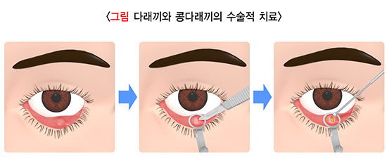 다래끼 그림