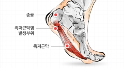 족저근막염 이미지