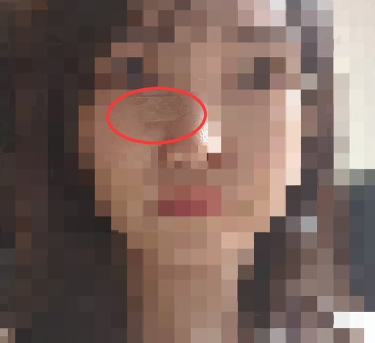 뾰루지를 짰는데 얼굴에 구멍이 생겼어요(위너확장구멍 없애기)