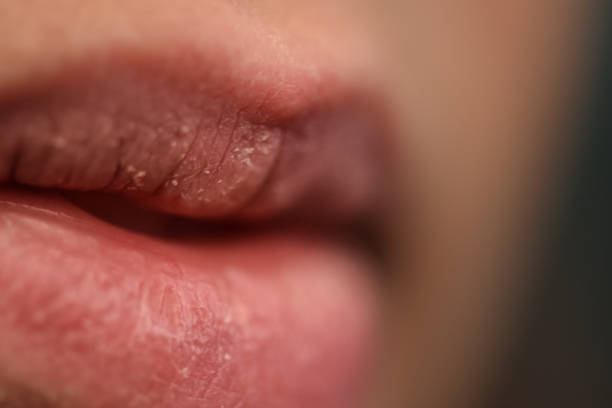 겨울철 입술 예방 완벽 가이드