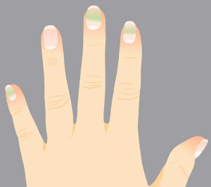 손톱에 생기기 쉬운 트러블