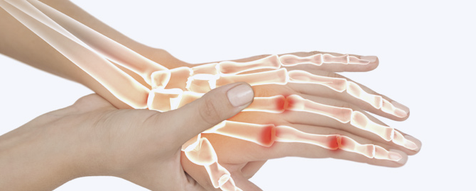 관절염 영양제1