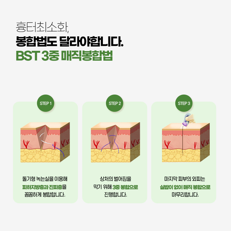 흉터최소화를 위해서는 봉합법도 달라야 합니다.
BST 비에스티 3중 매직 봉합법

1. 돌기형 녹는실을 이용해 피하지방층과 진피층을 꼼꼼하게 봉합합니다.
2. 상처의 벌어짐을 막기 위해 3중 봉합으로 진행합니다.
3. 마지막 피부의 외피는 실밥 없이 매직 봉합으로 마무리합니다.