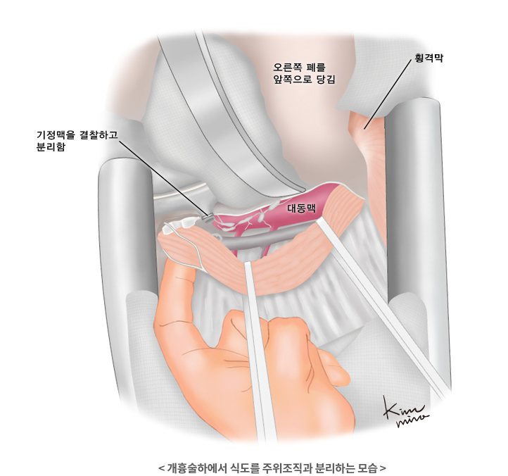식도암