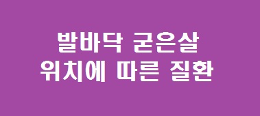 발바닥 굳은살 위치