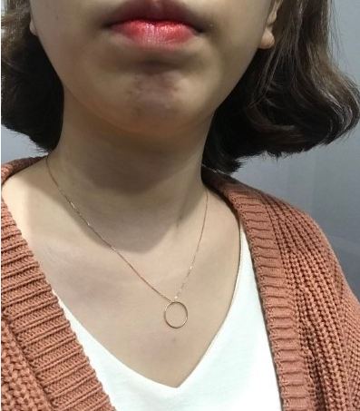 이중턱 보톡스 후기