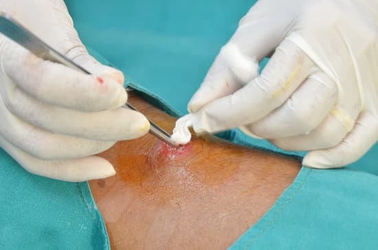 항문농양 수술 후 관리법