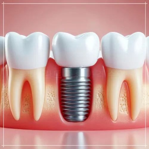 티타늄 임플란트: 특징, 비용, 수명1