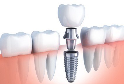 [Q&amp;A] 임플란트 수술 과정, 기간, 종류, 수명, 가격, 치료방법