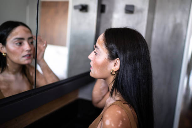 피부색이 달라지는 얼굴 백반증, 치료 가능할까?