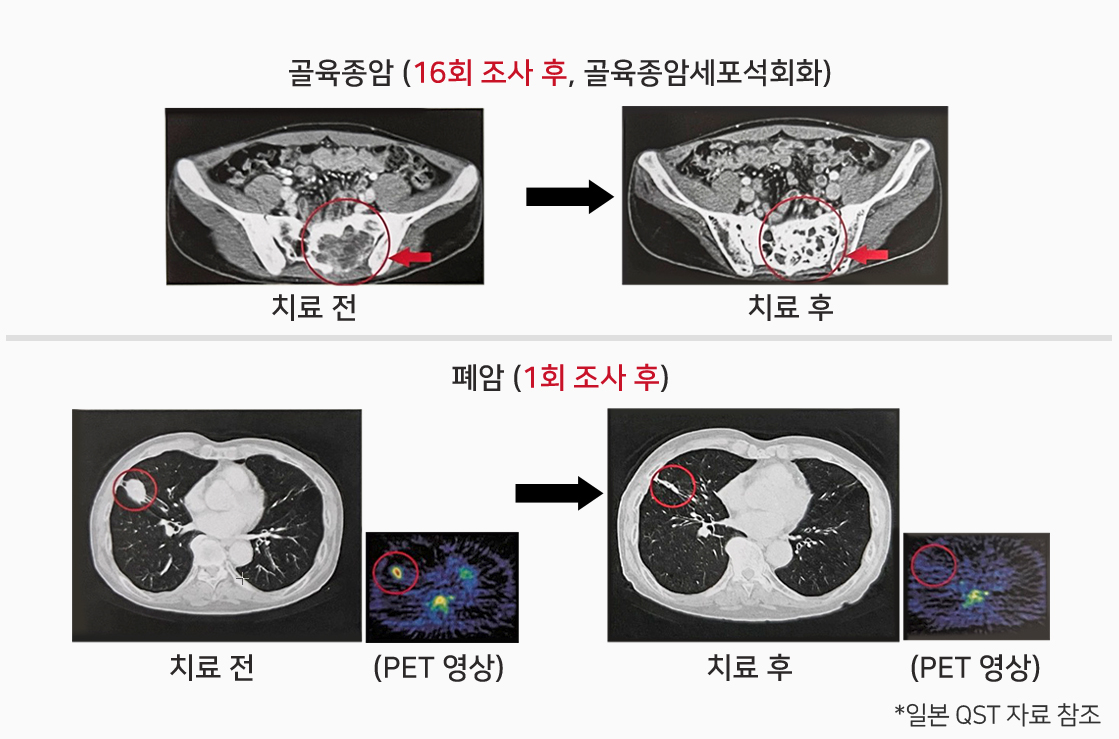 암 방사능 치료