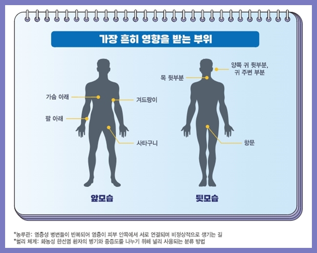 화농성 한선염 질환