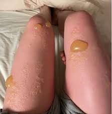 화상 물집 치료방법&amp;#44; 터뜨리지 말고 이렇게 치료하세요!