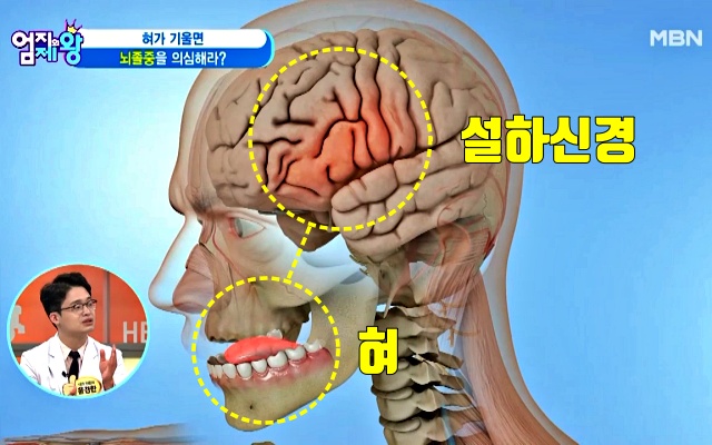 혀로 보는 뇌졸중 초기증상 뇌졸중 자가진단법, 혀 기울기, 혀 건강체크, 혀 건강상태, 건강 팁줌 매일꿀정보