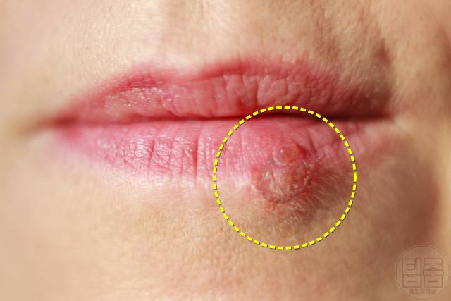 피부암 호발 부위 피부암자가진단 아랫입술