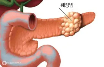 췌장암 초기 증상 췌장암 등통증 위치 검사_2