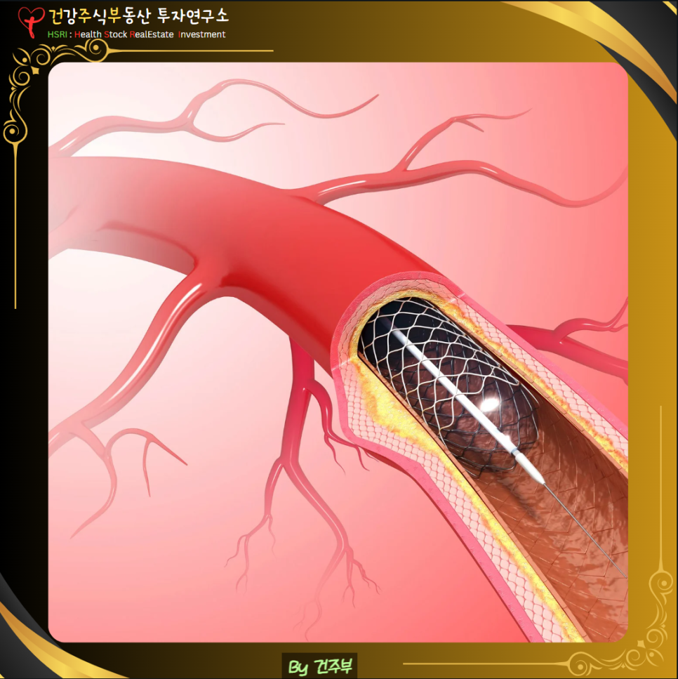 심근경색 원인과 치료방법
(글 그림 : 건주부, 그림 출처 : Canva)