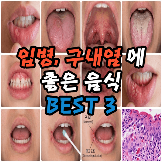 구내염에 좋은 음식
